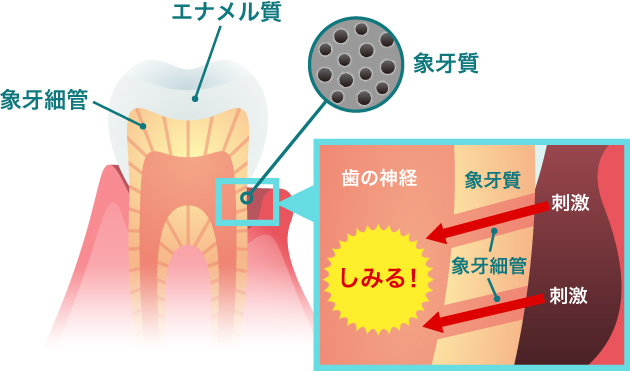 ルートケア？そもそも知覚過敏とは？